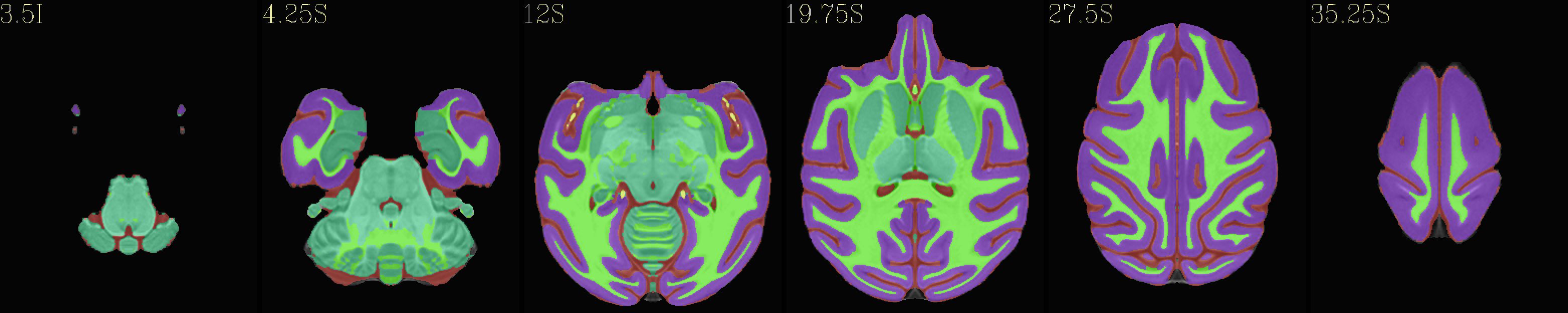 ../../_images/img_nmt2.0symss_segmentation.axi.png